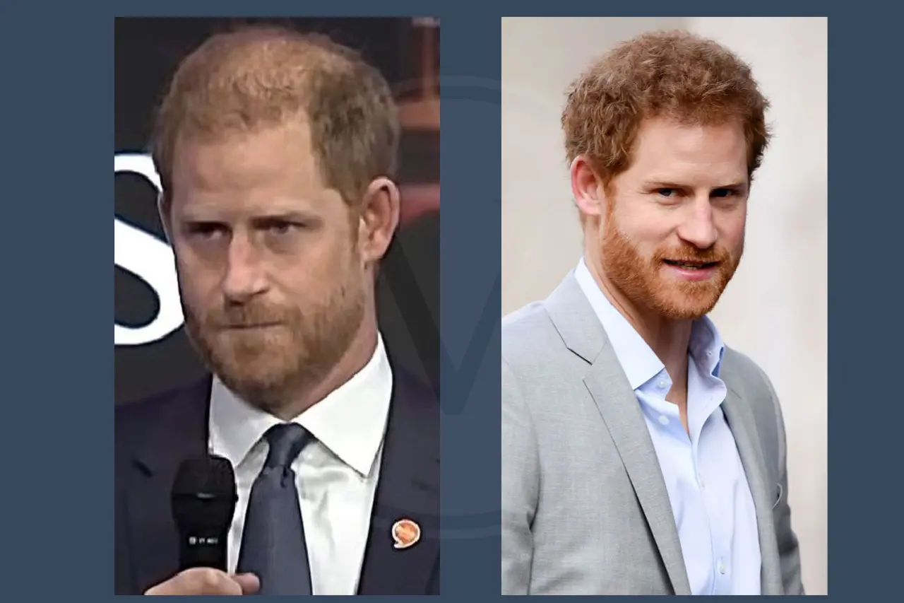 Prince Harry Hair Transplant Before and After