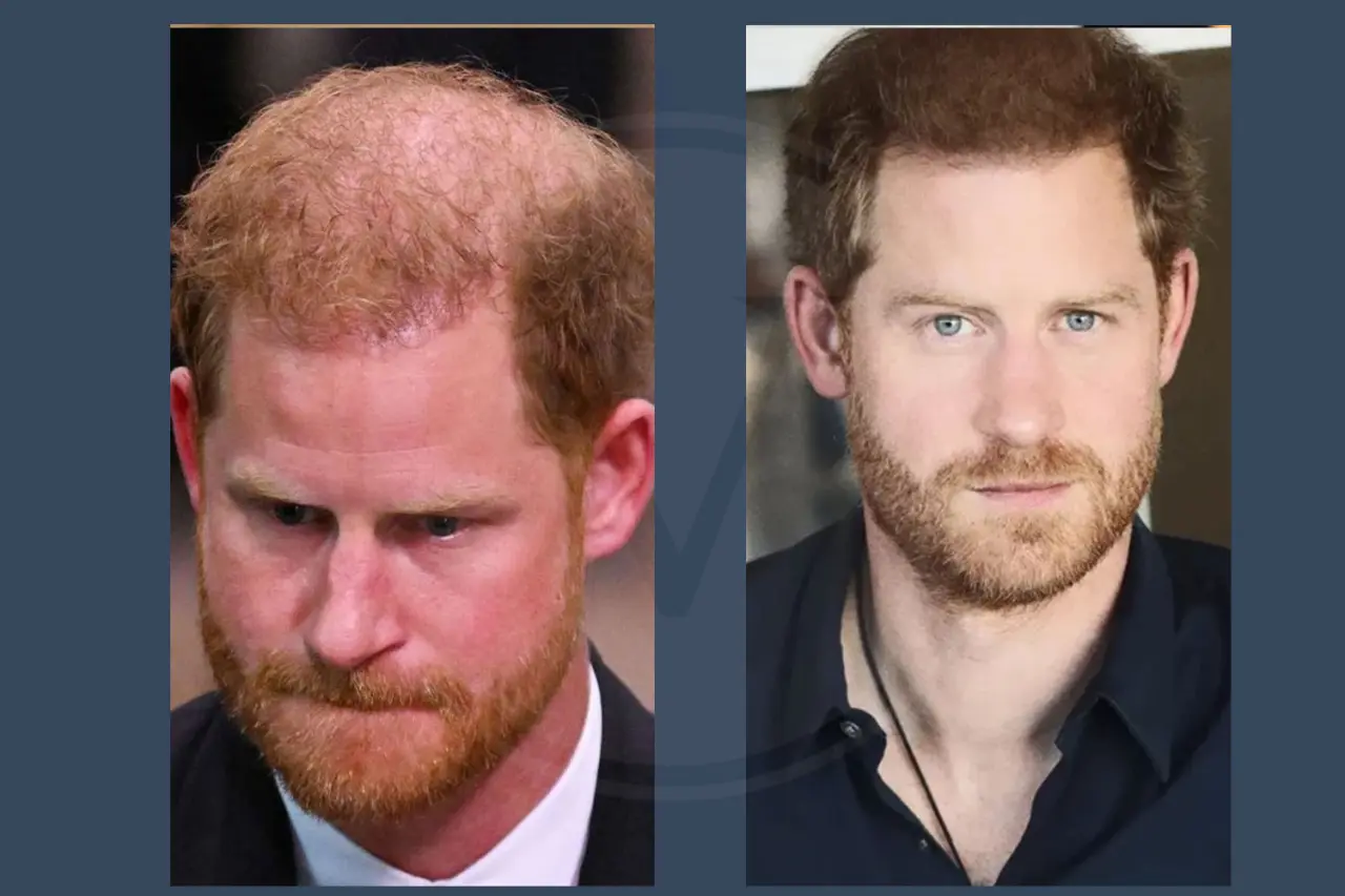 Celebrity Hair Transplant Prince Harry