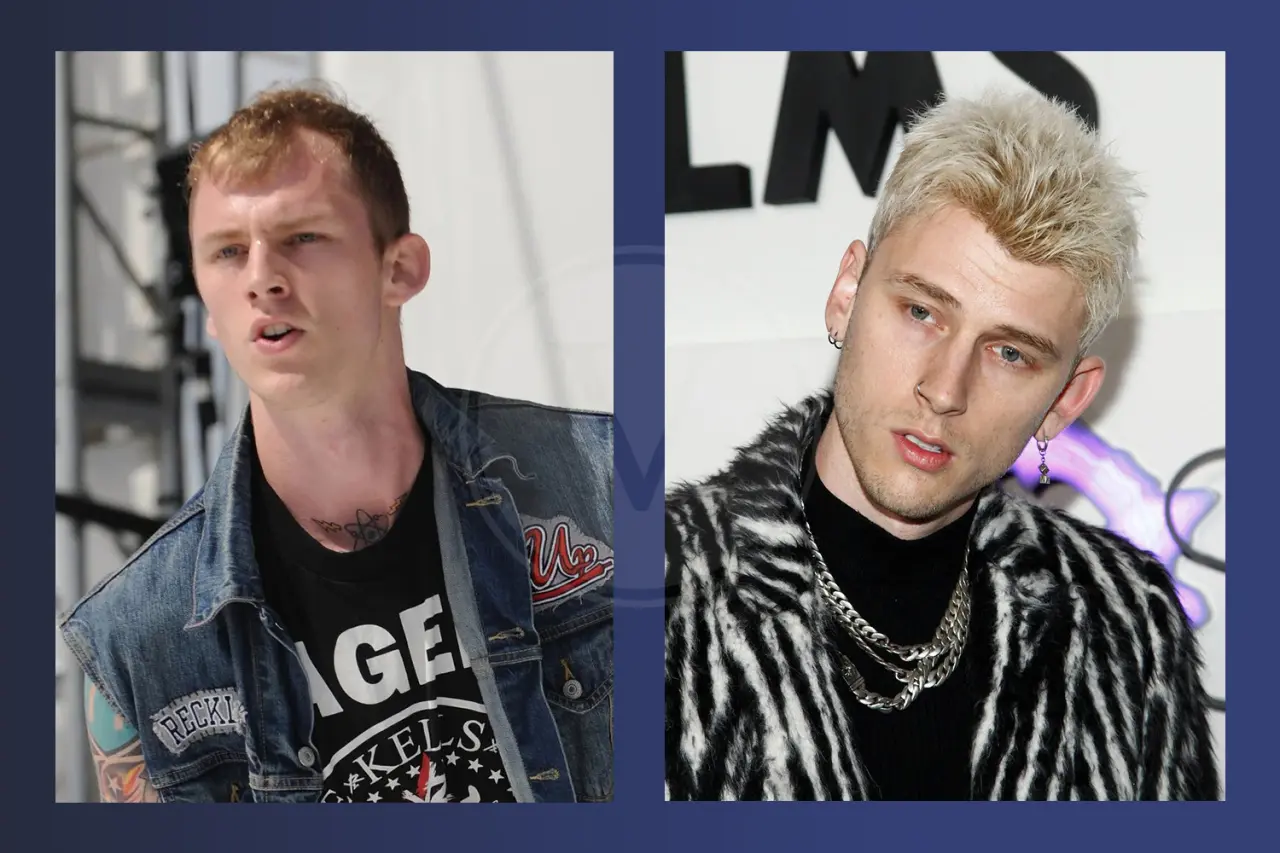 MGK Before and After Hair Transplant Results