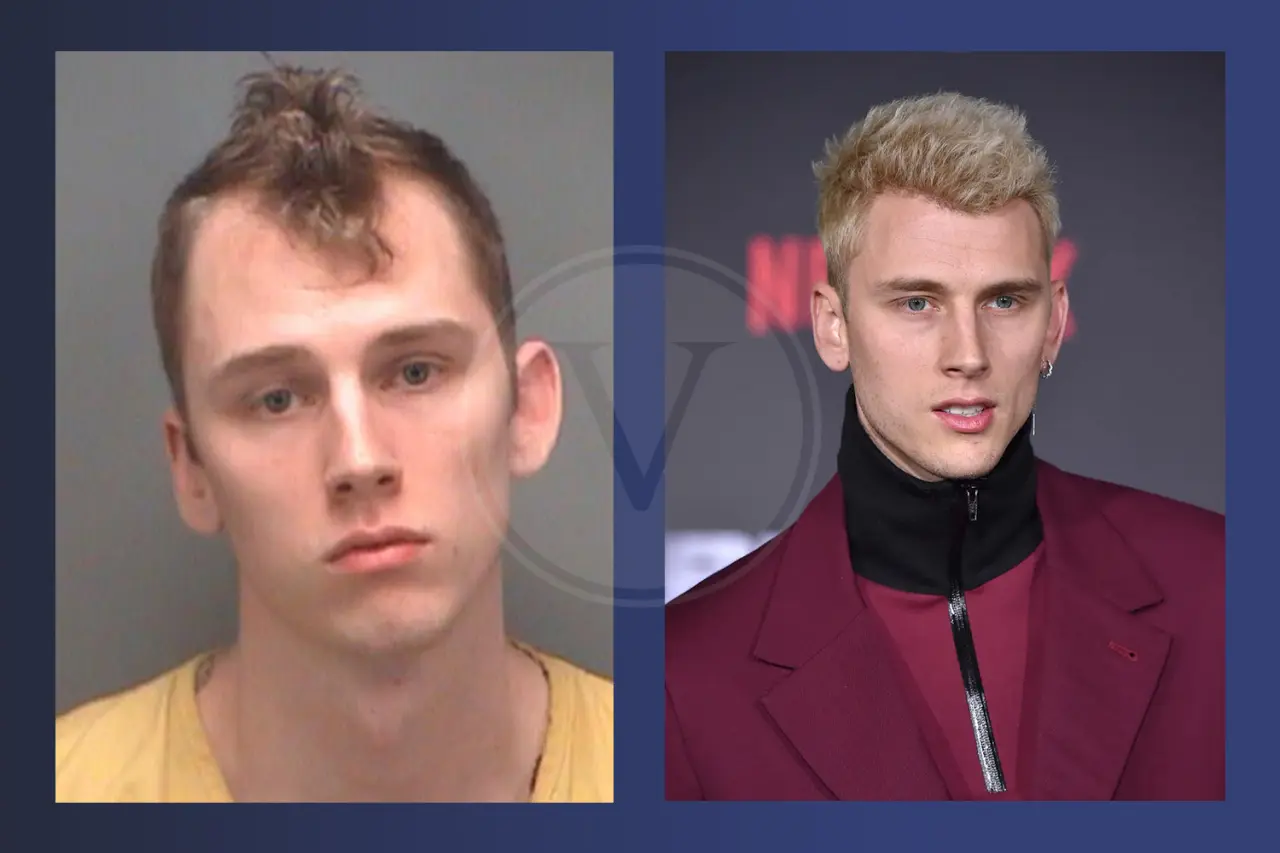 MGK Before and After Hair Transplant Results