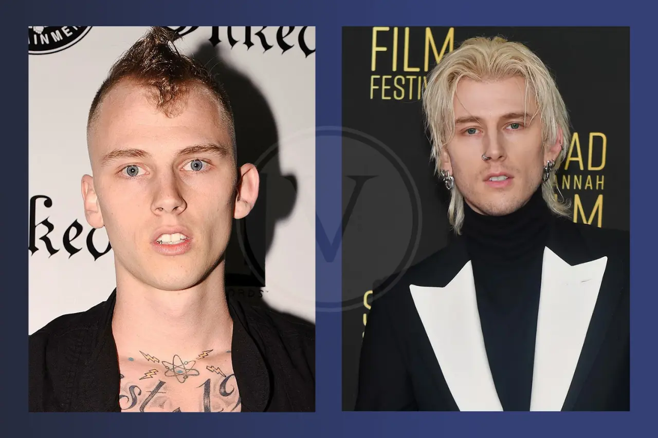 MGK Before and After Hair Transplant Results