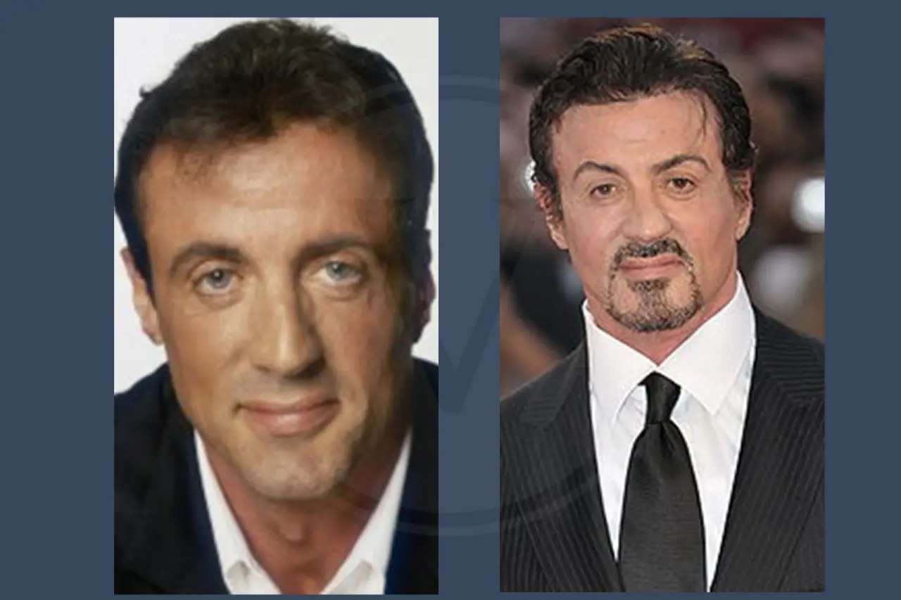 Sylvester Stallone Before and After Hair Transplant