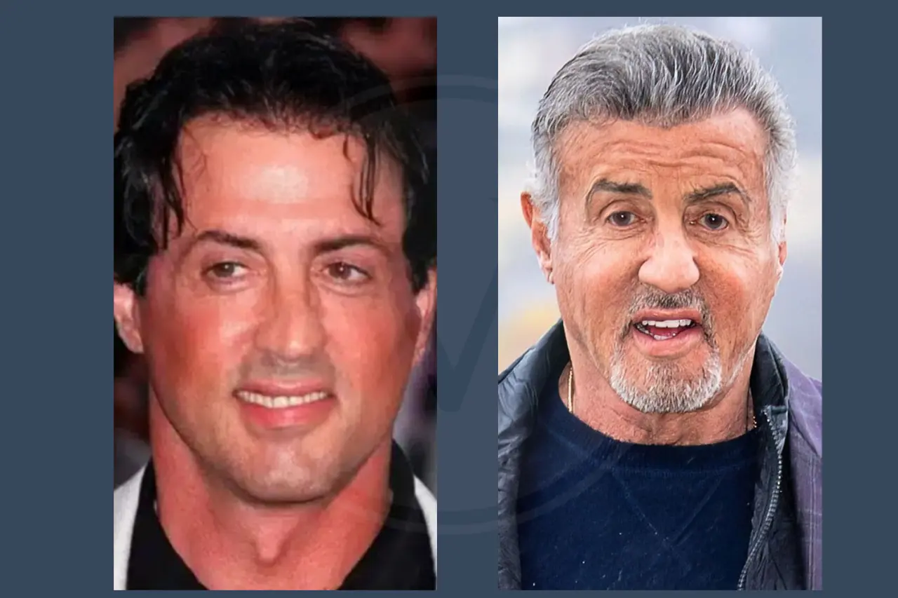 Celebrity Hair Transplant Sylvester Stallone