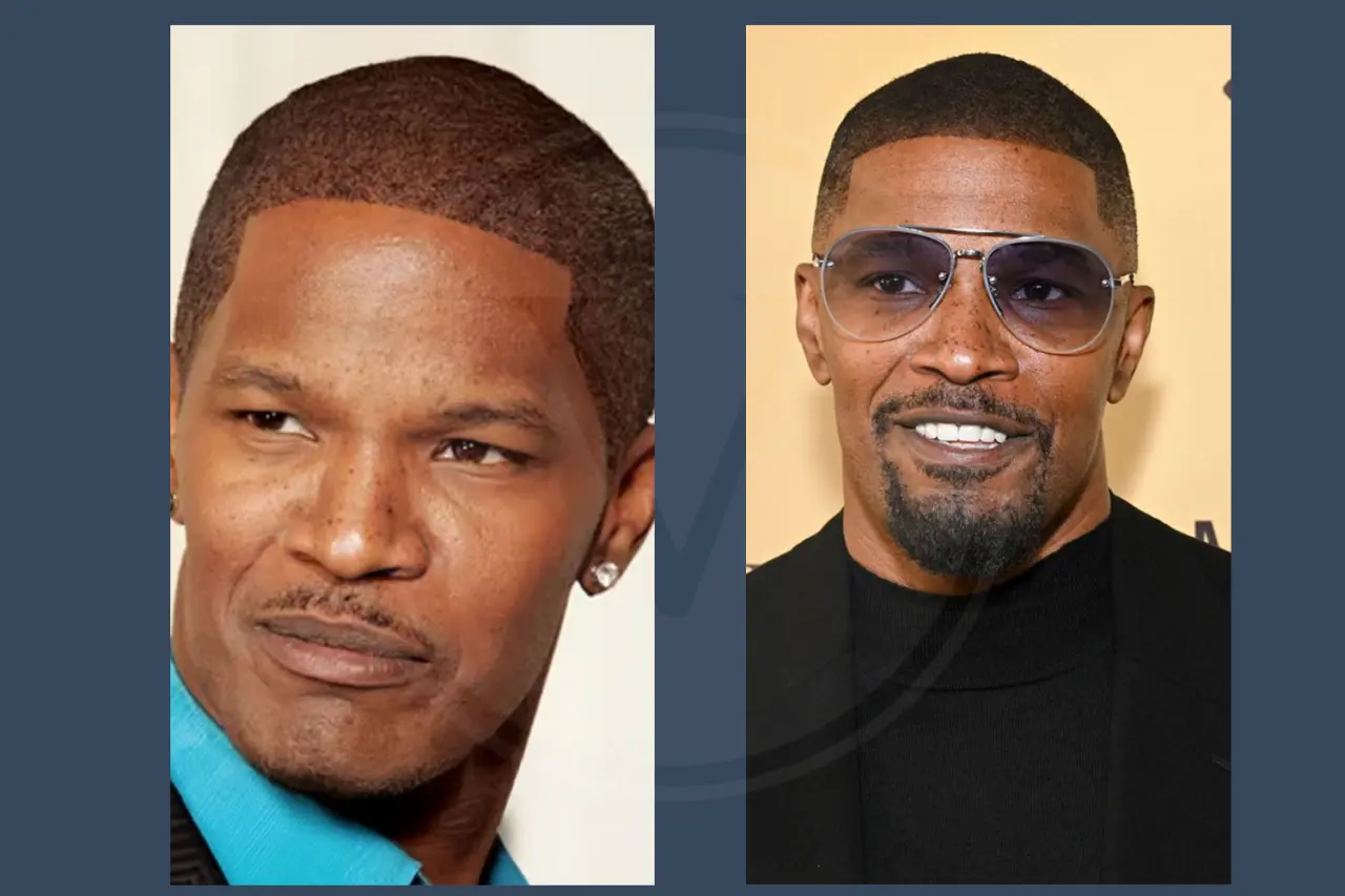 Jamie Foxx Before and After Hair Transplant