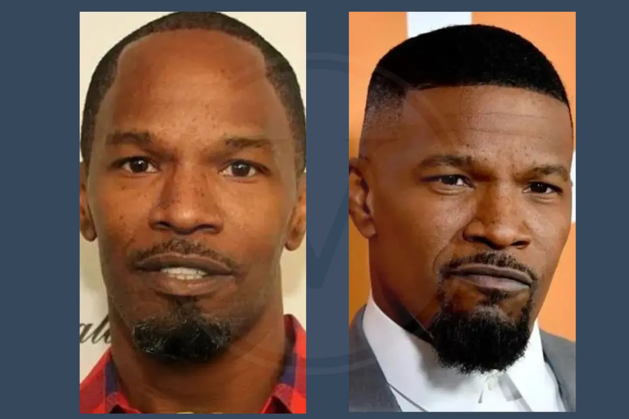Jamie Foxx Before and After Hair Transplant