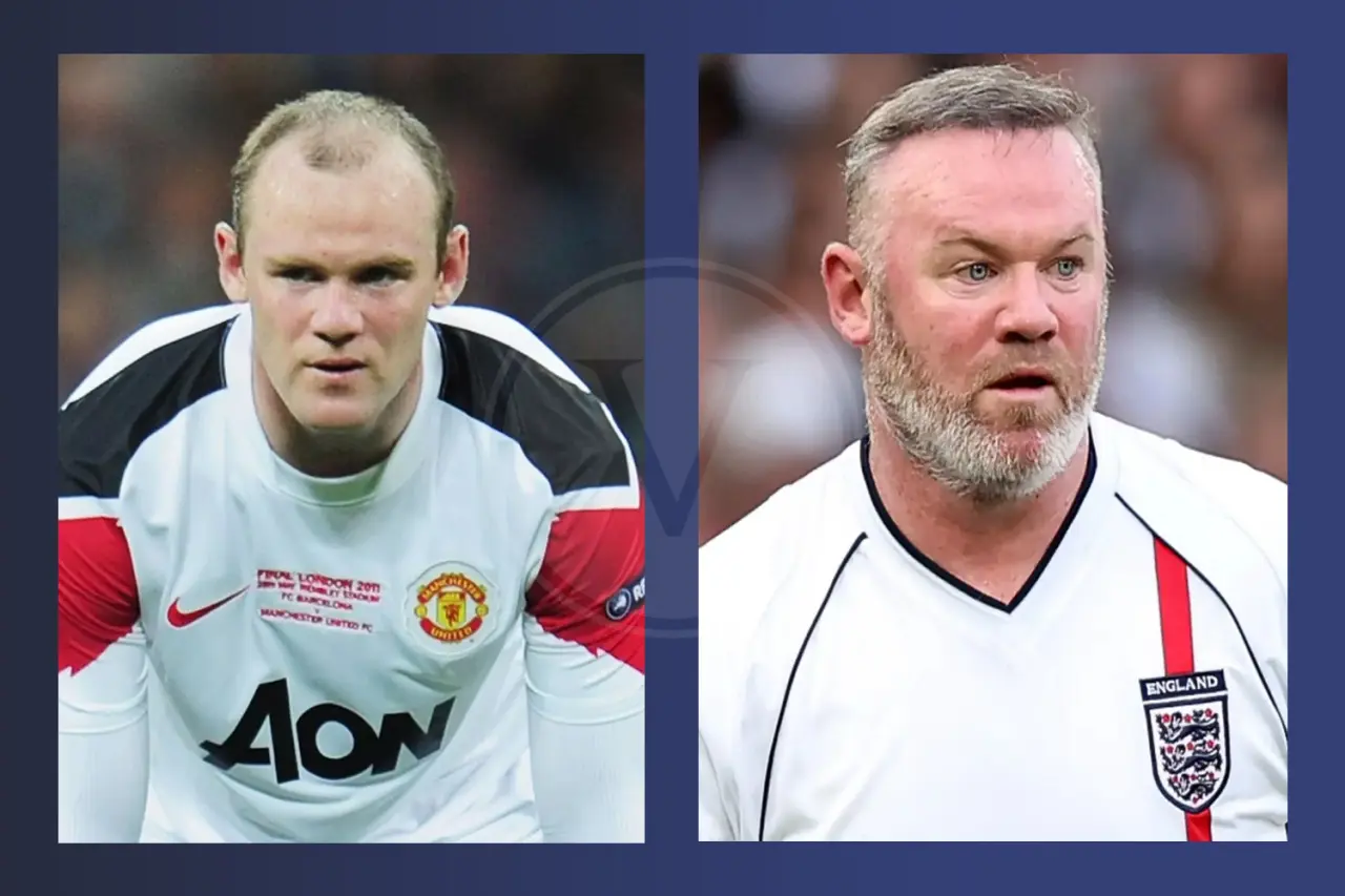 Wayne Rooney Before and After Hair Transplant