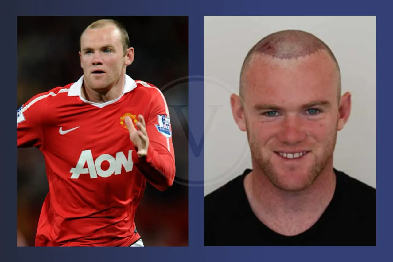 Wayne Rooney Before and After Hair Transplant