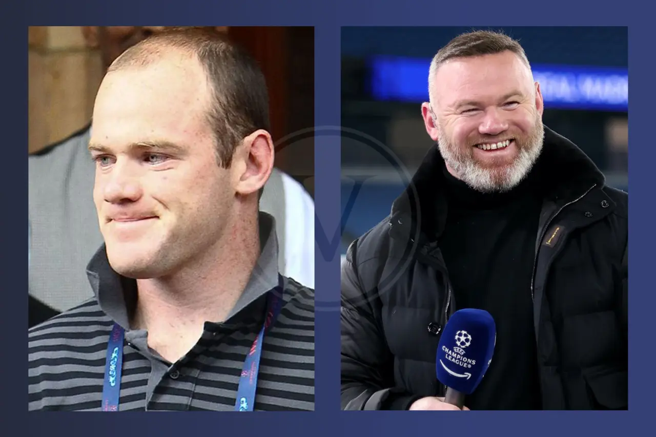 Wayne Rooney Before and After Hair Transplant