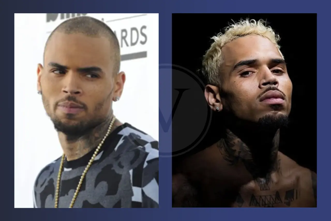 Chris Brown Before and After Hair Transplant