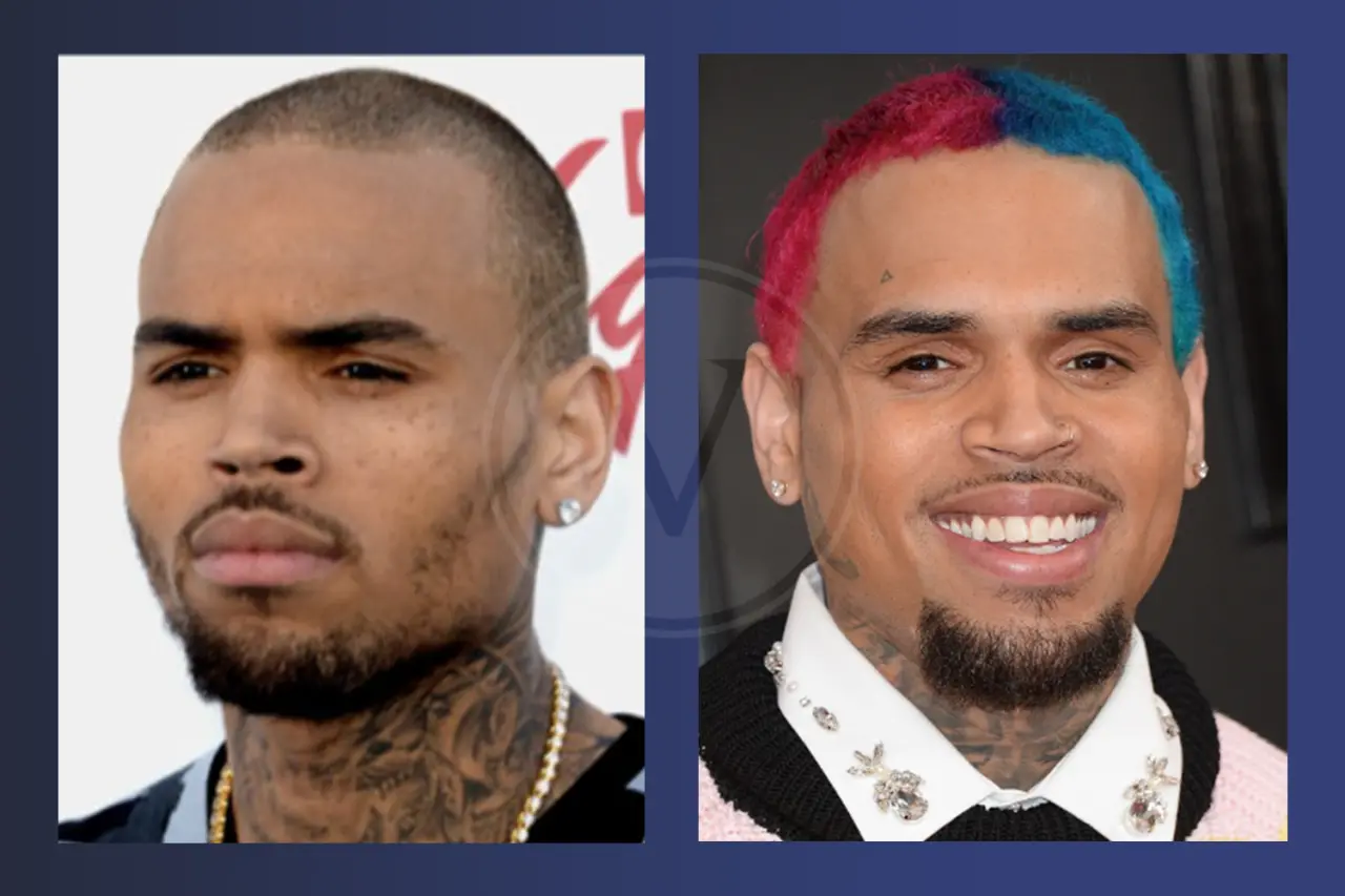 Chris Brown Before and After Hair Transplant