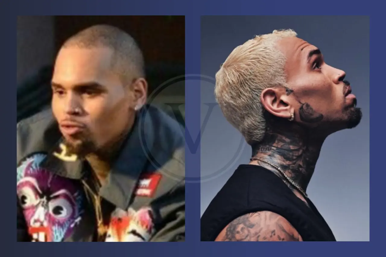 Celebrity Hair Transplant Chris Brown