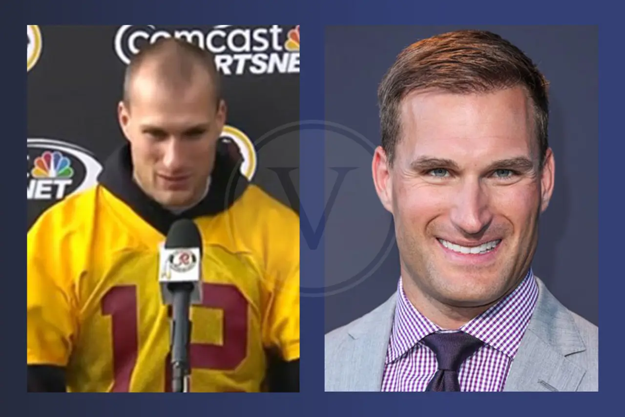 Kirk Cousins Before and After Hair Transplant
