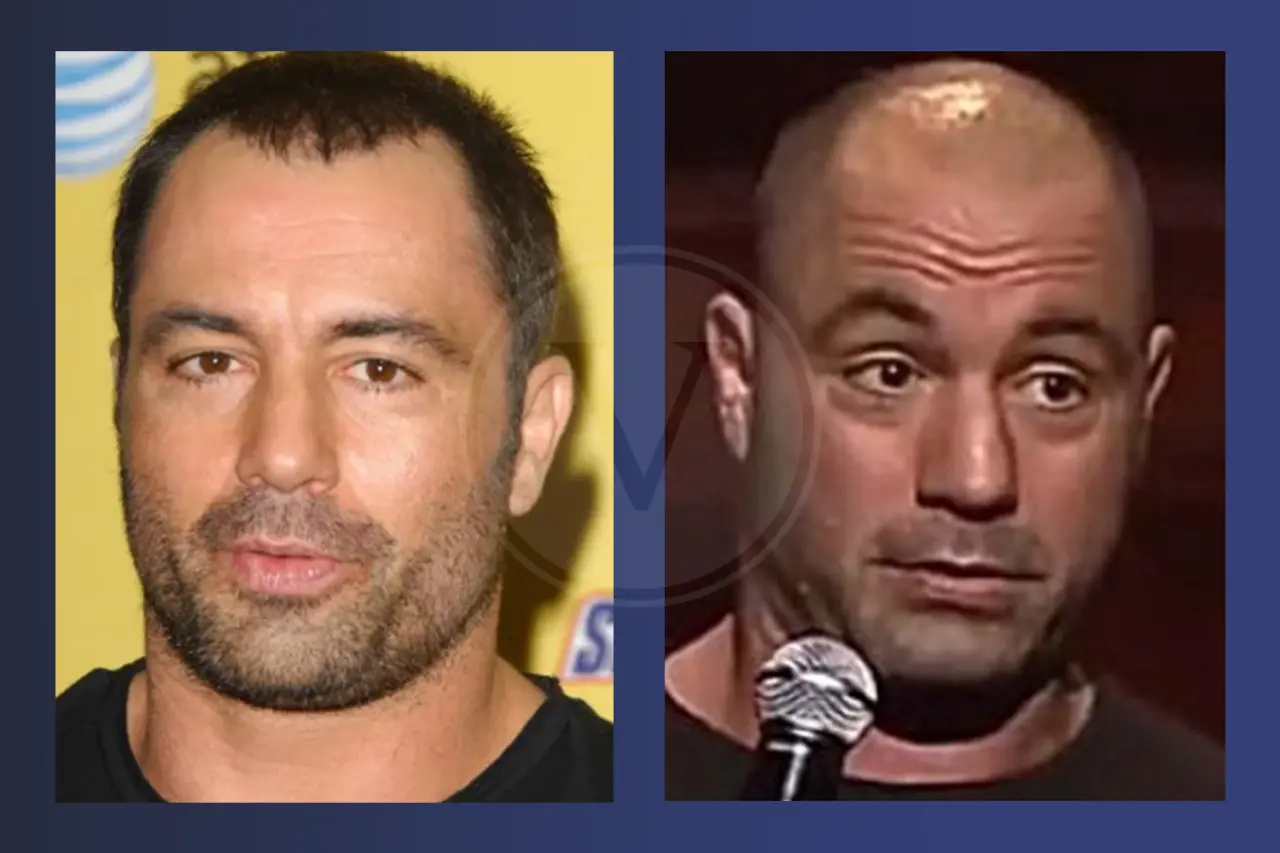 Joe Rogan Before and After Hair Transplant