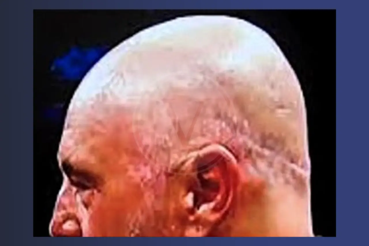 Joe Rogan Hair Transplant Scar
