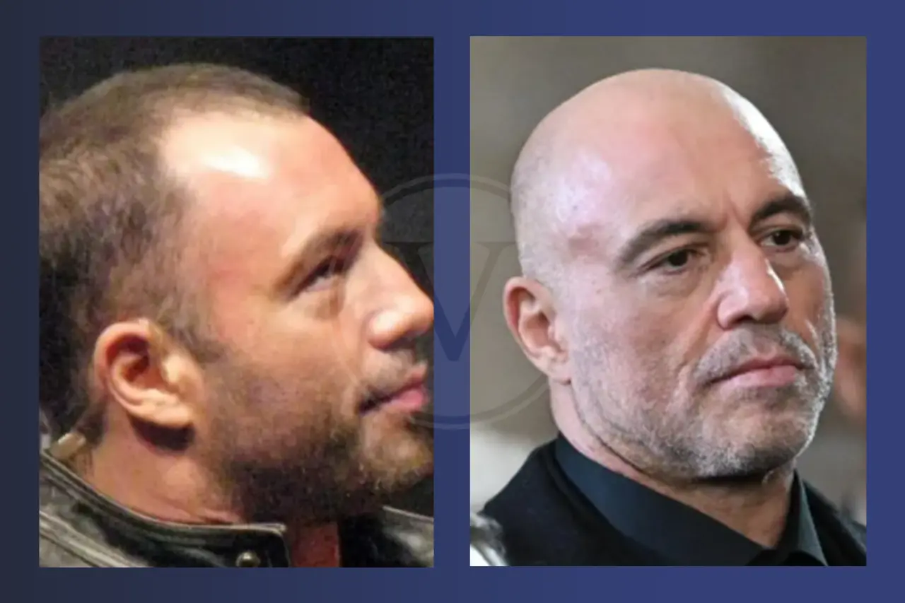 Joe Rogan Before and After Hair Transplant