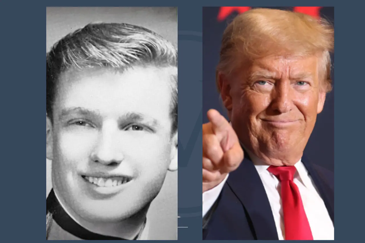 Donald Trump Before and After Hair Transplant 