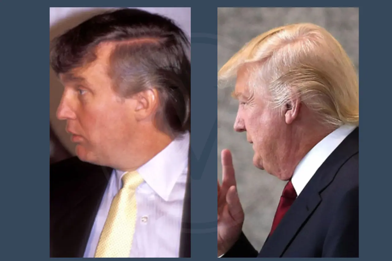 Donald Trump Before and After Hair Transplant 