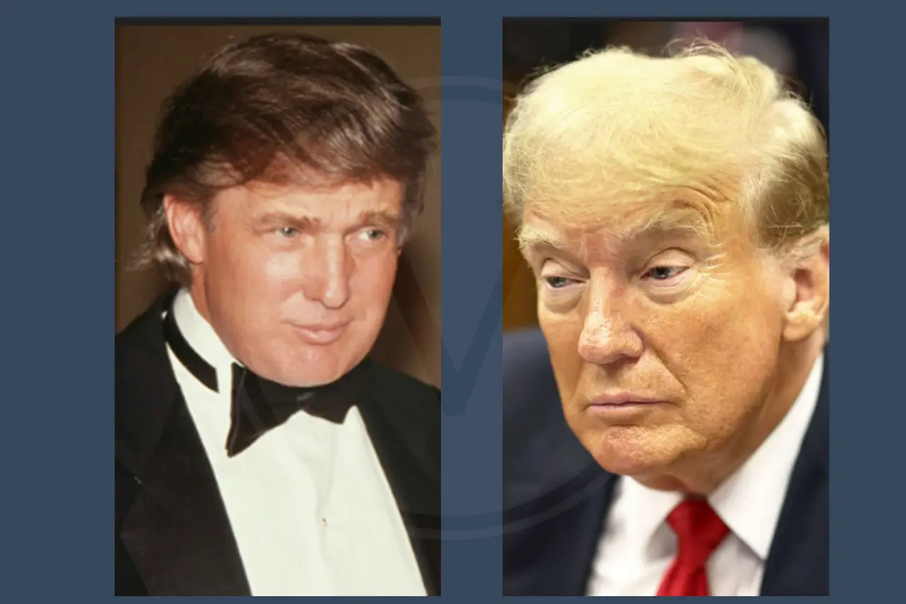 Donald Trump Before and After Hair Transplant 