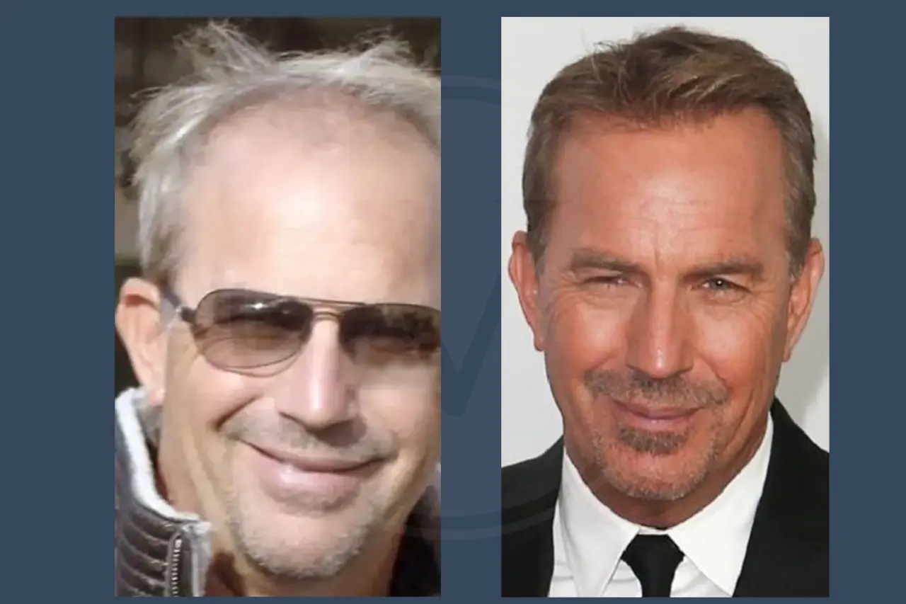 Kevin Costner Before and After Hair Transplant 