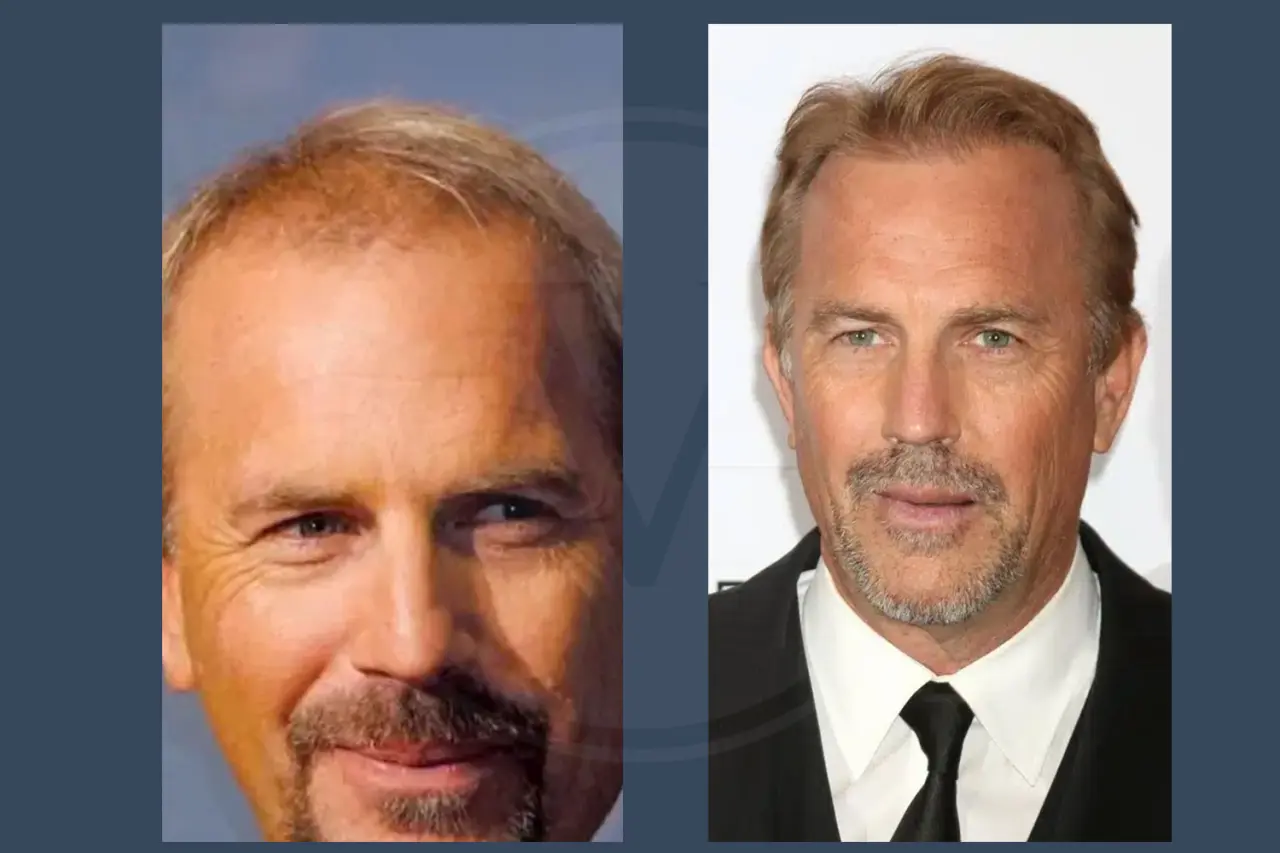 Kevin Costner Before and After Hair Transplant 