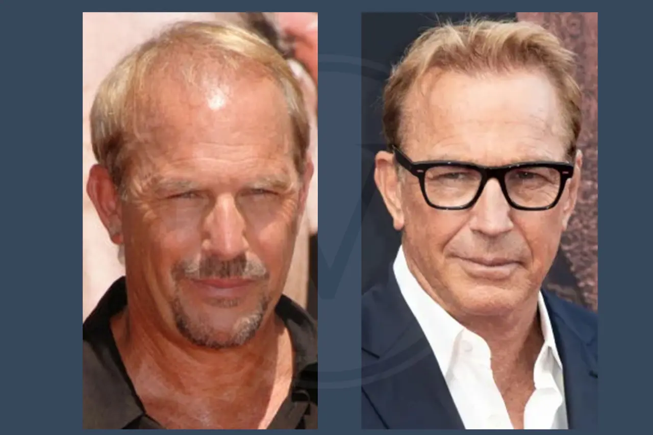 Kevin Costner Before and After Hair Transplant 