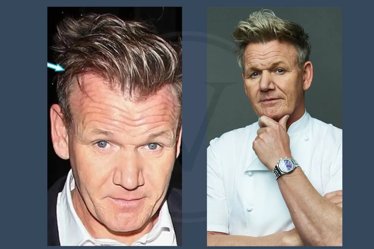 Gordon Ramsay Before and After Hair Transplant