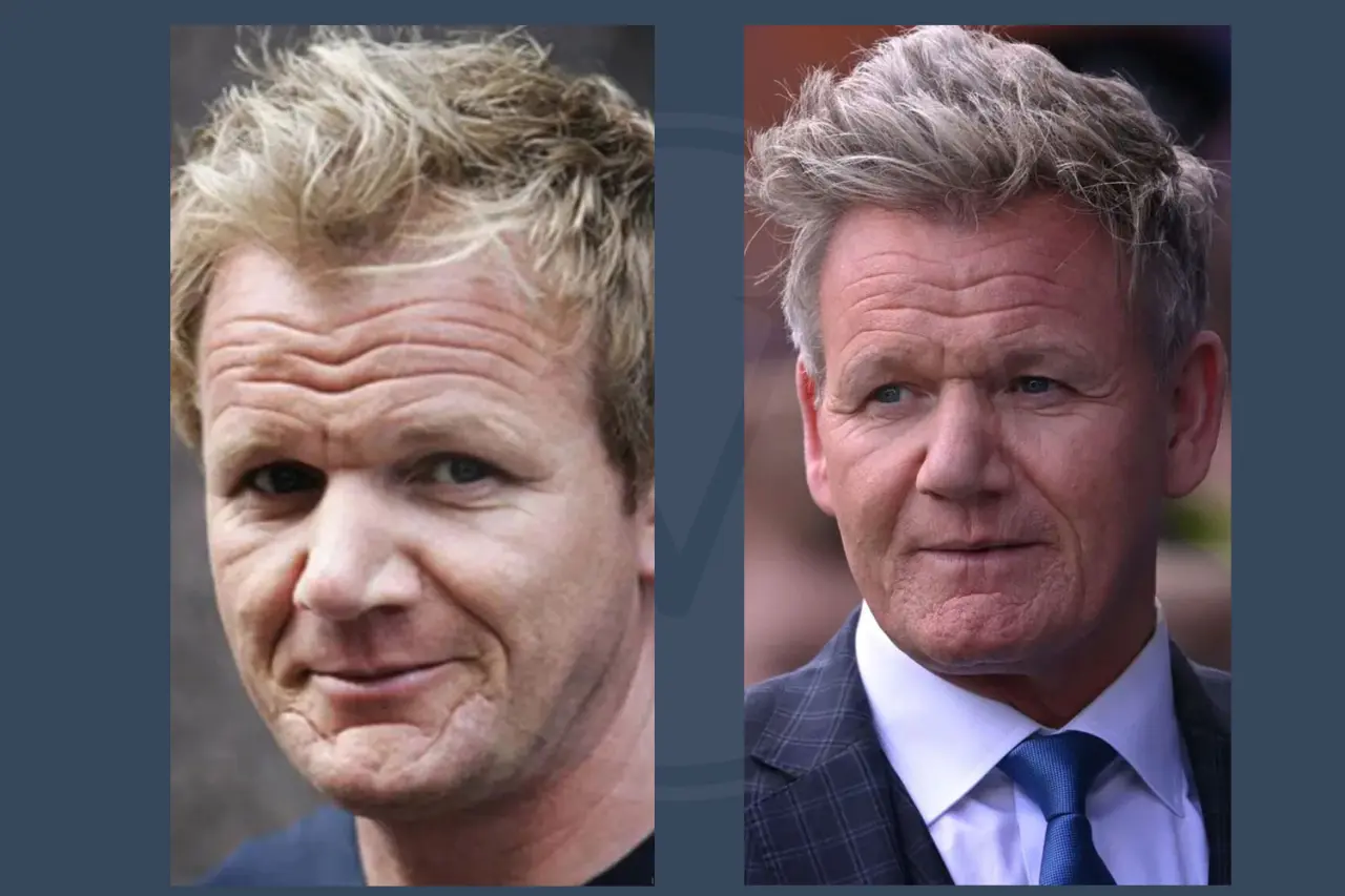 Gordon Ramsay Before and After Hair Transplant