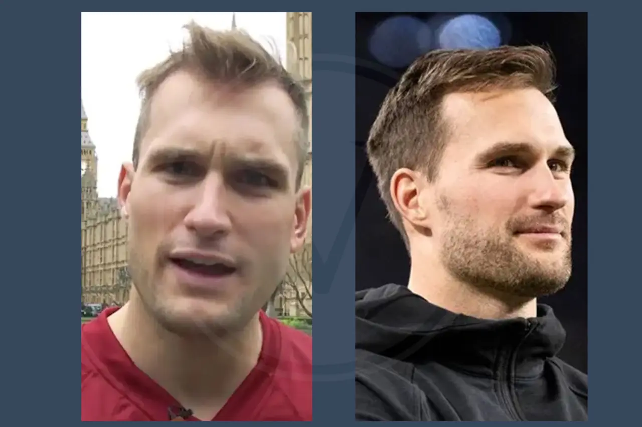 Celebrity Hair Transplant Kirk Cousins