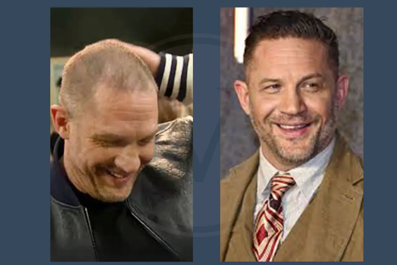 Tom Hardy Before and After Hair Transplant