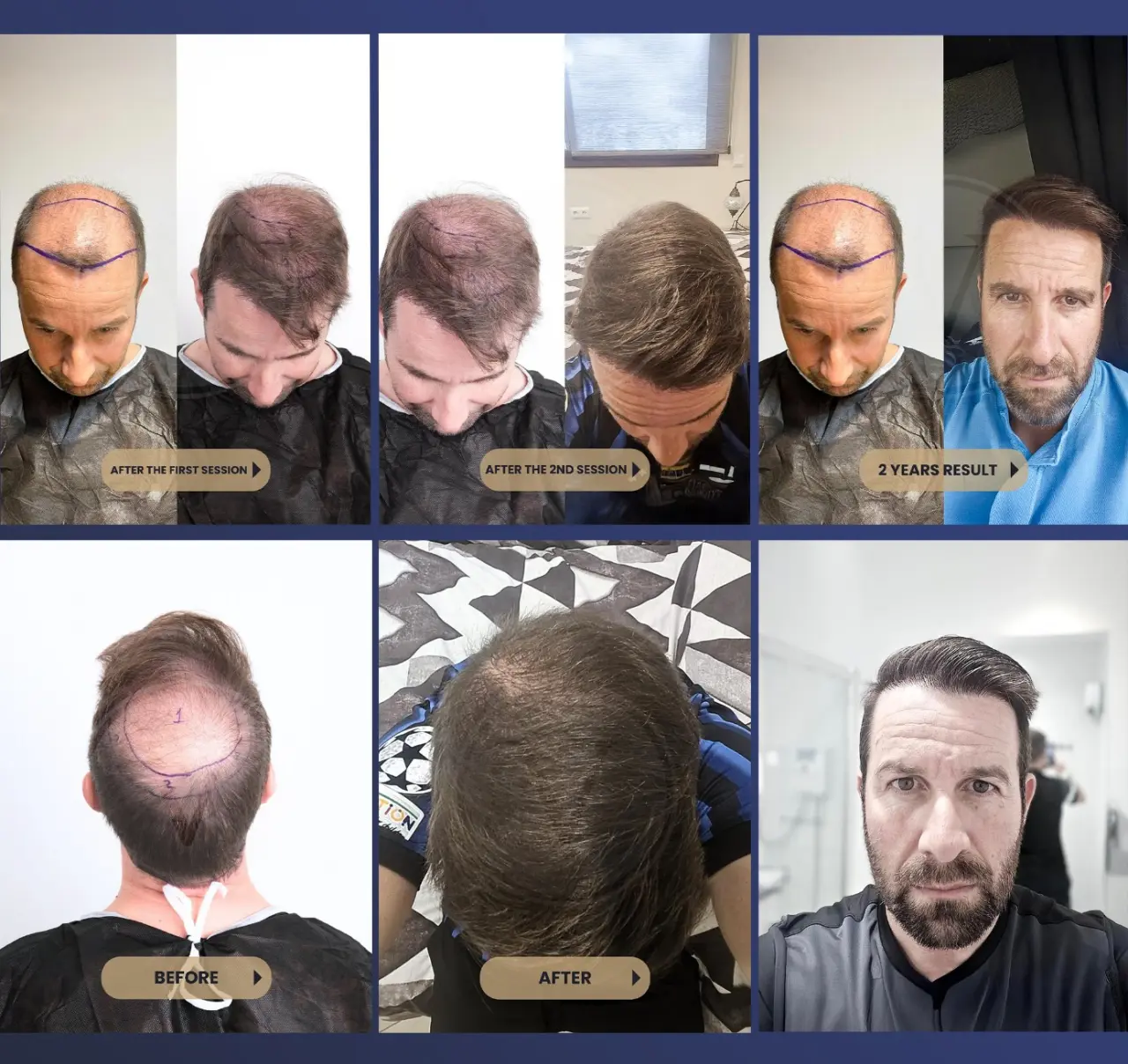 Best Hair Transplant Clinic in Turkey Istanbul