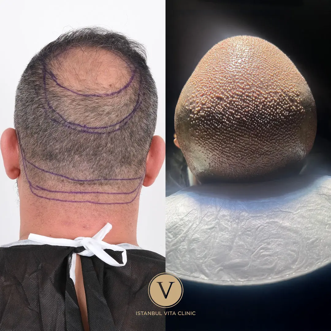 Hair Transplant Recovery Timeline