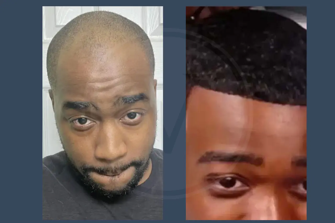JiDion Before and After Hair Transplant
