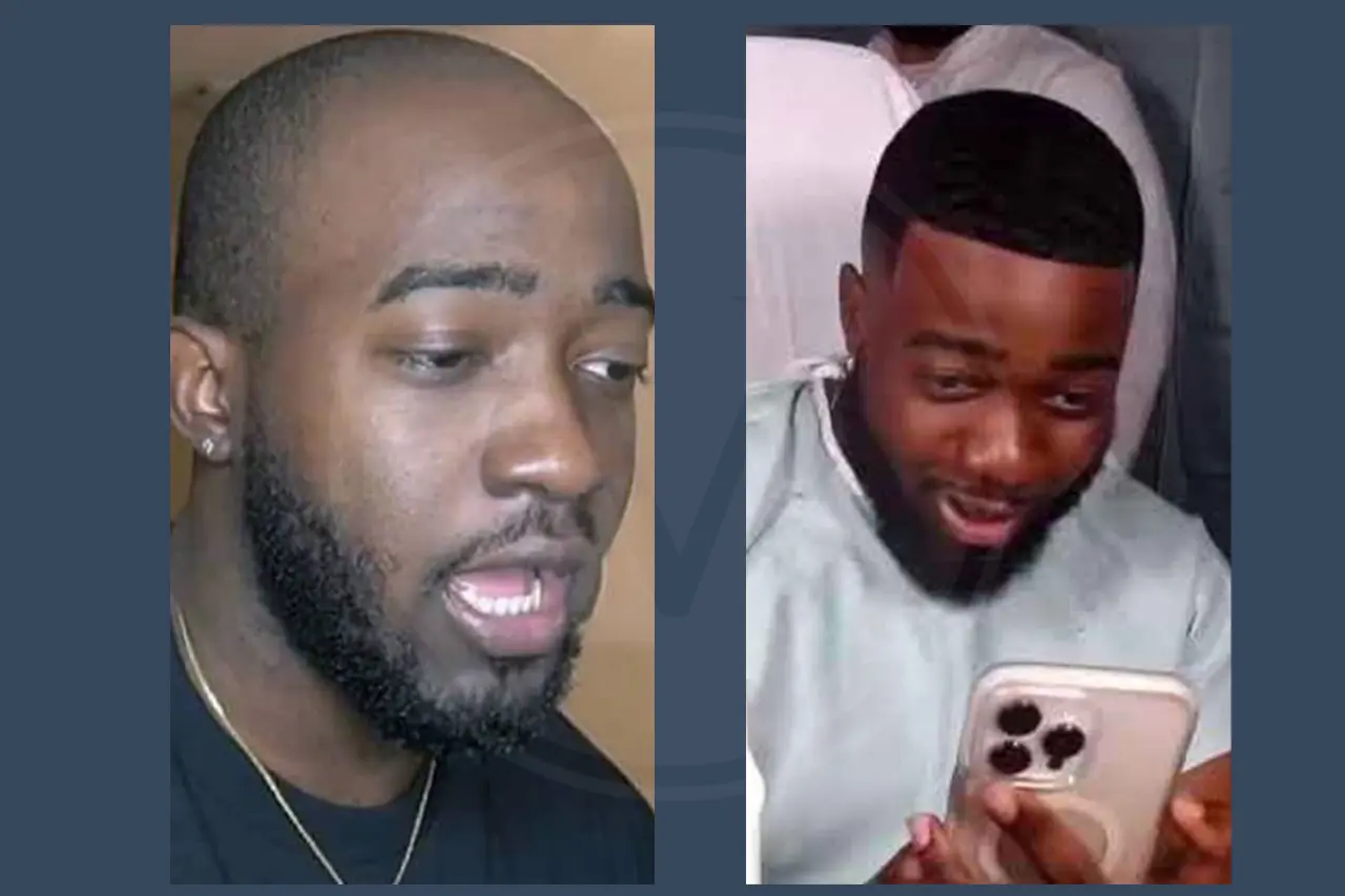 JiDion Before and After Hair Transplant