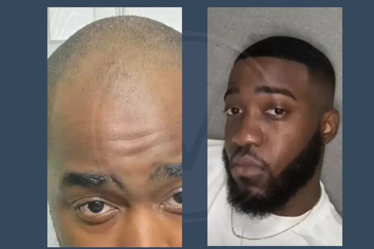 JiDion Before and After Hair Transplant