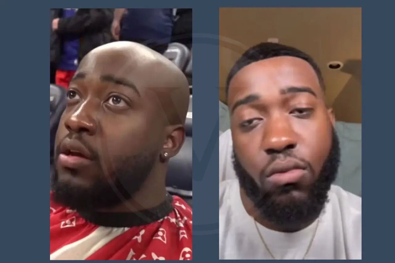 Celebrity Hair Transplant JiDion