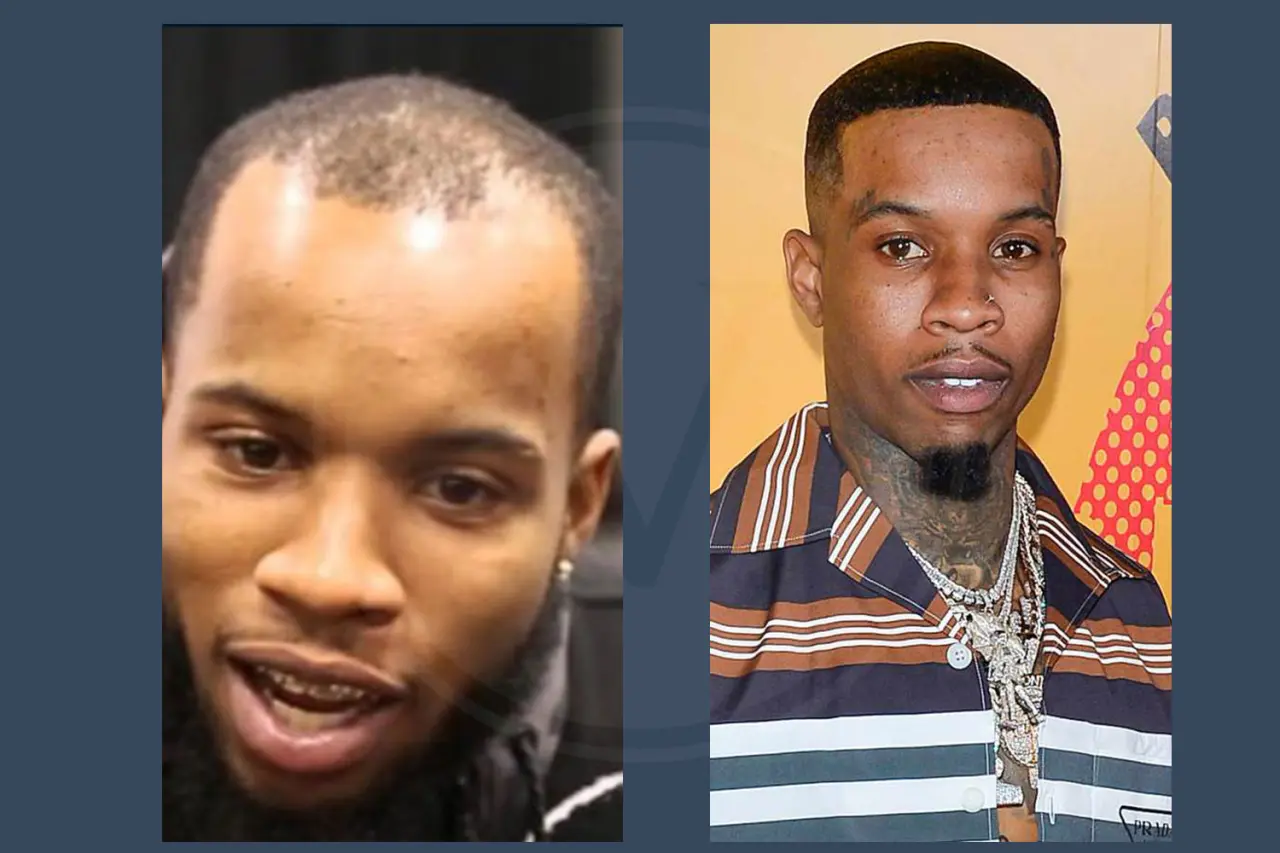 Tory Lanez Before And After Hair Transplant Results