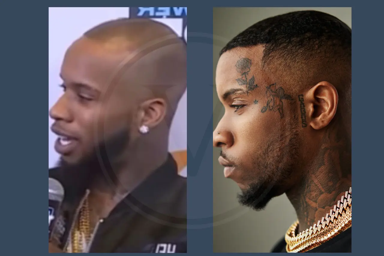 Tory Lanez Before And After Hair Transplant Results