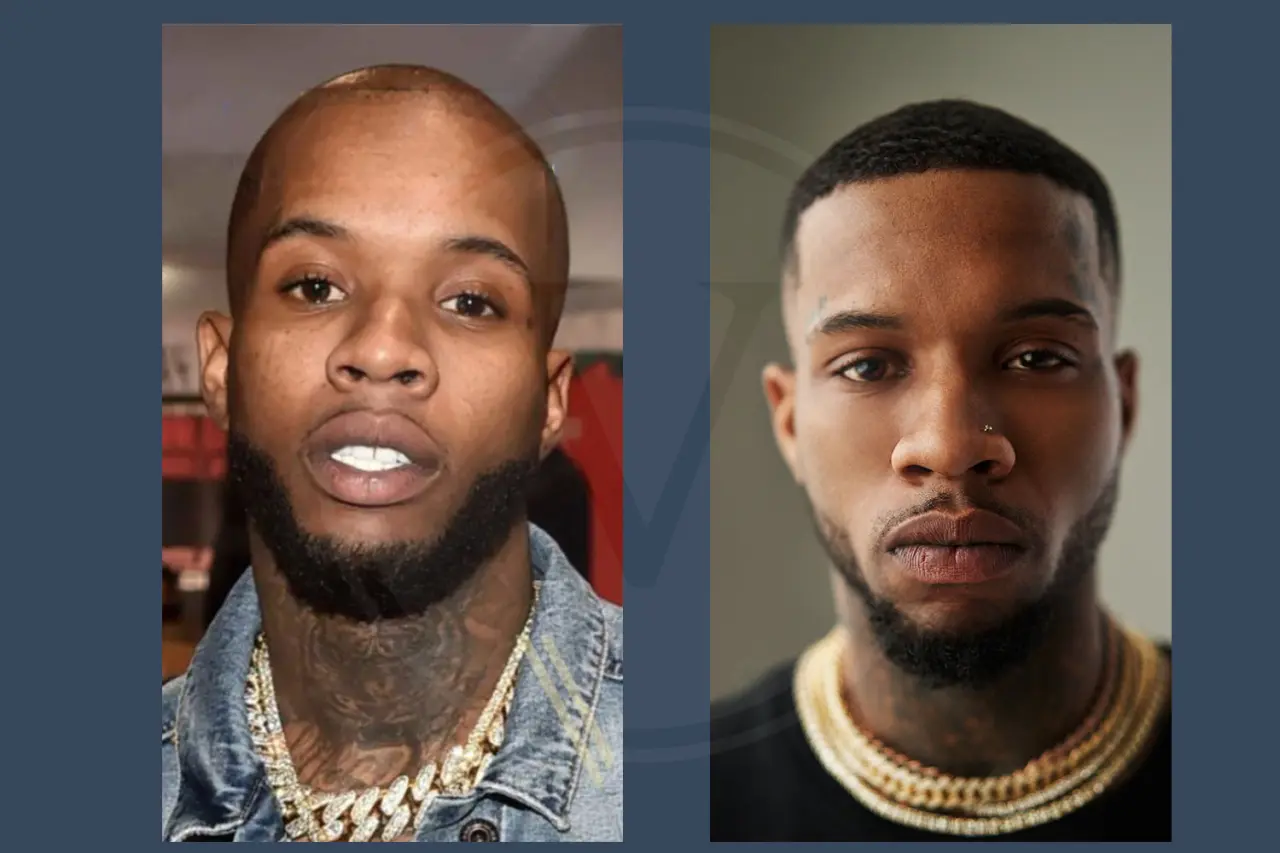 Tory Lanez Before And After Hair Transplant Results