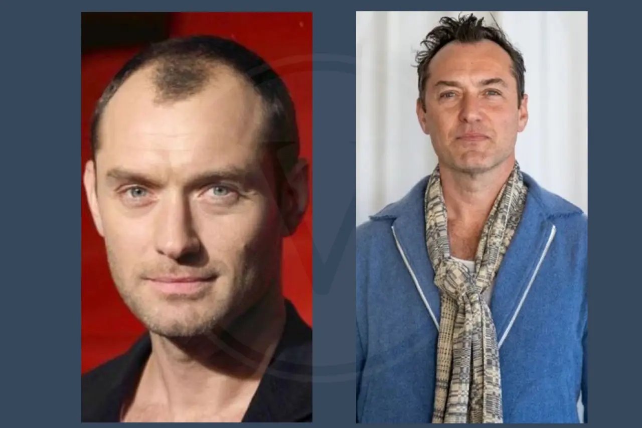 Jude Law Before and After Hair Transplant