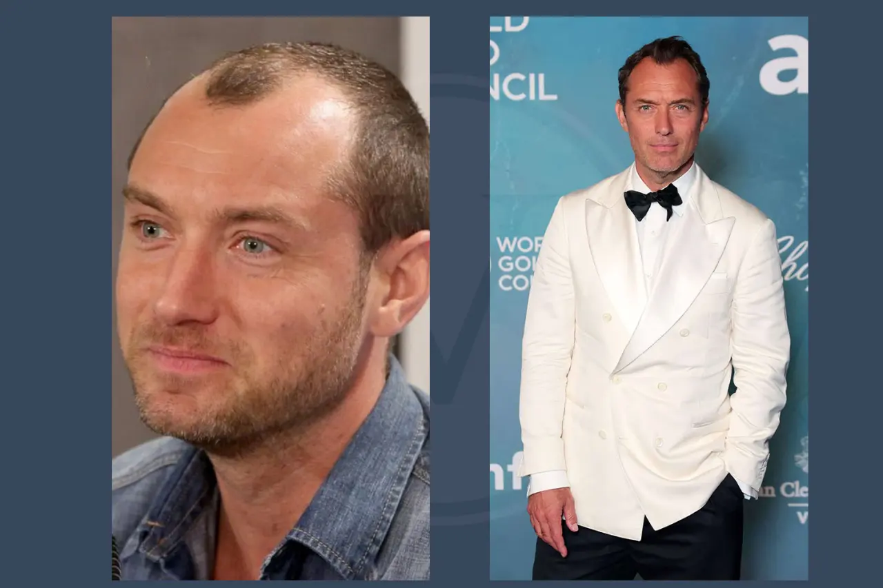 Celebrity Hair Transplant Jude Law