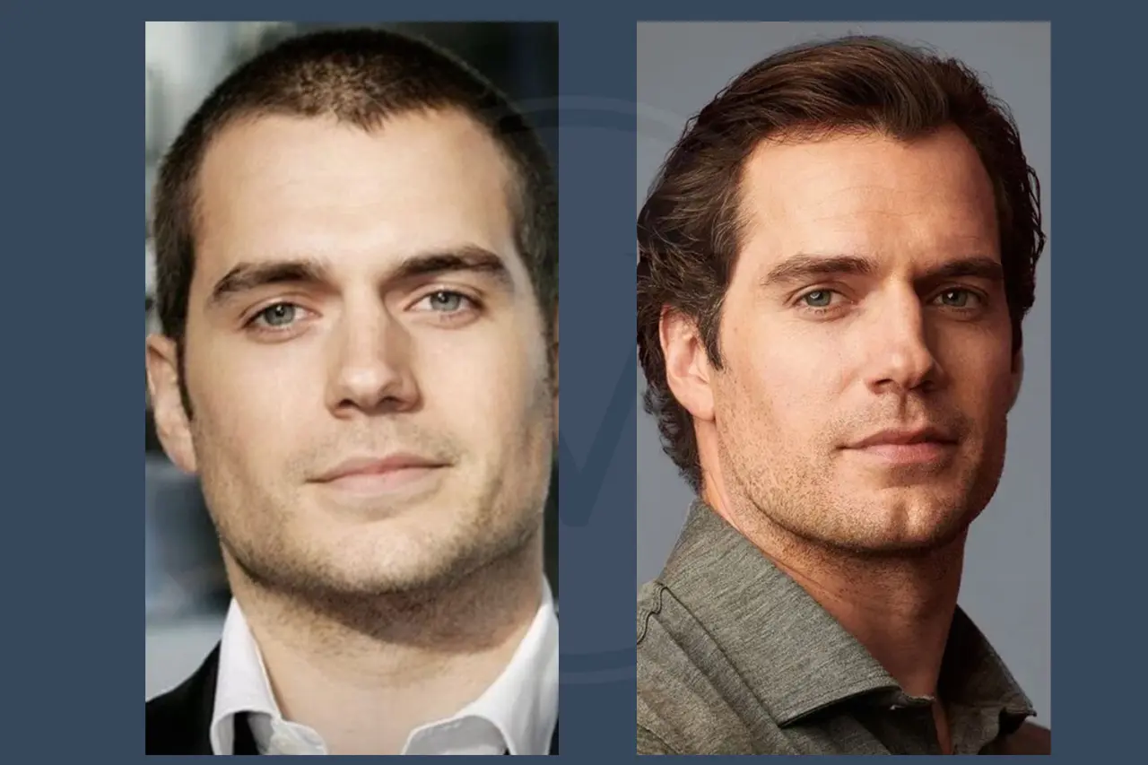 Henry Cavill Hair Transplant Before And After