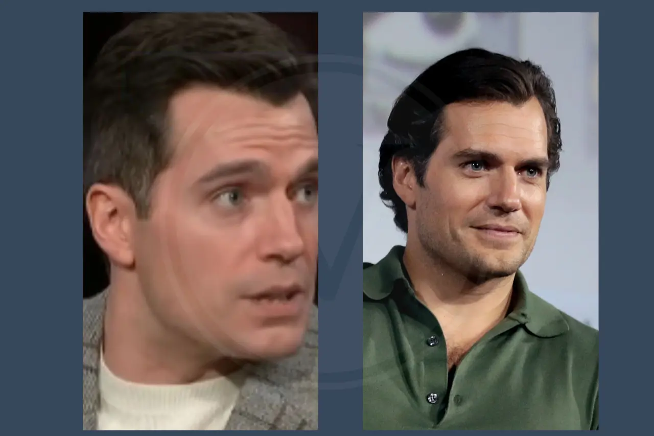 Henry Cavill Hair Transplant Before And After