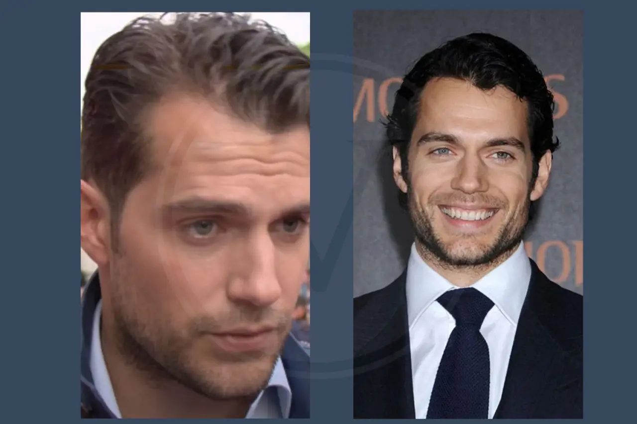 Henry Cavill Hair Transplant Before And After