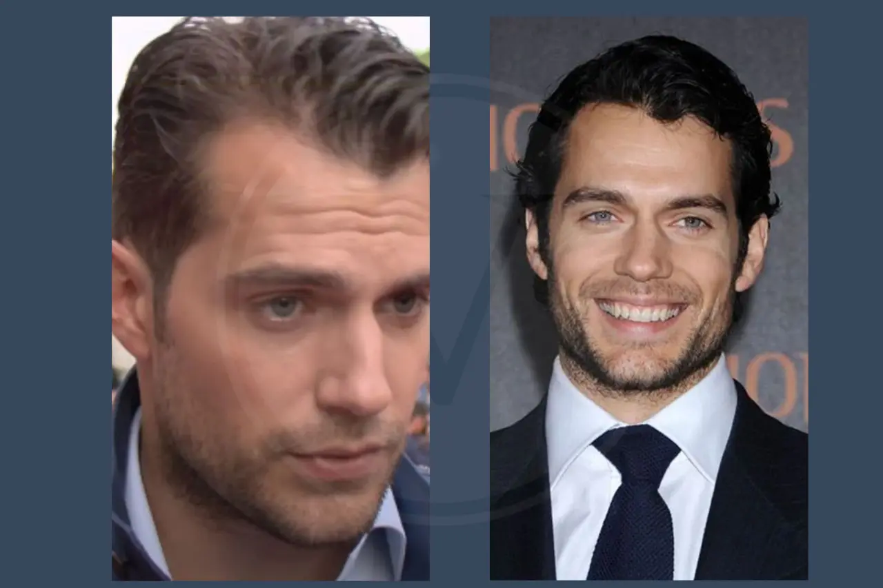 Celebrity Hair Transplant Henry Cavill
