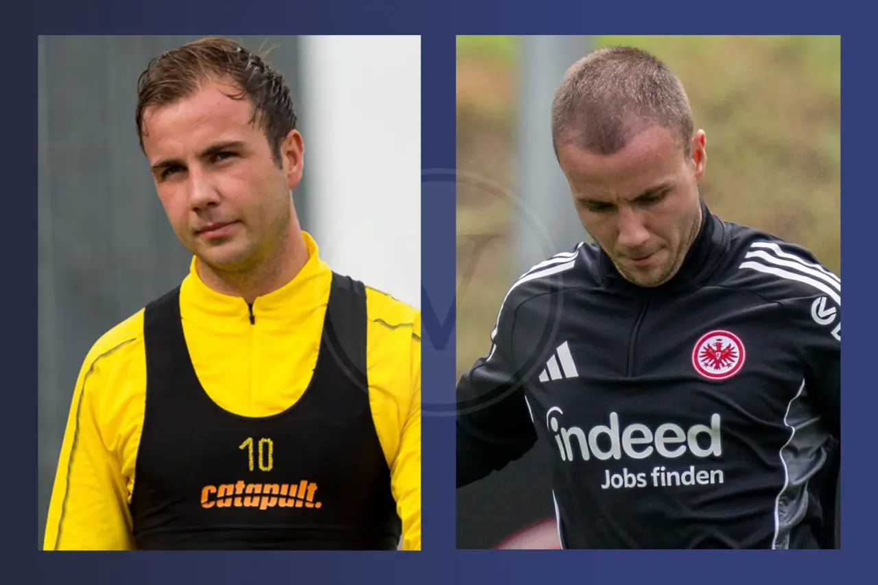 Mario Götze Haartransplantation: Vorher und Nachher