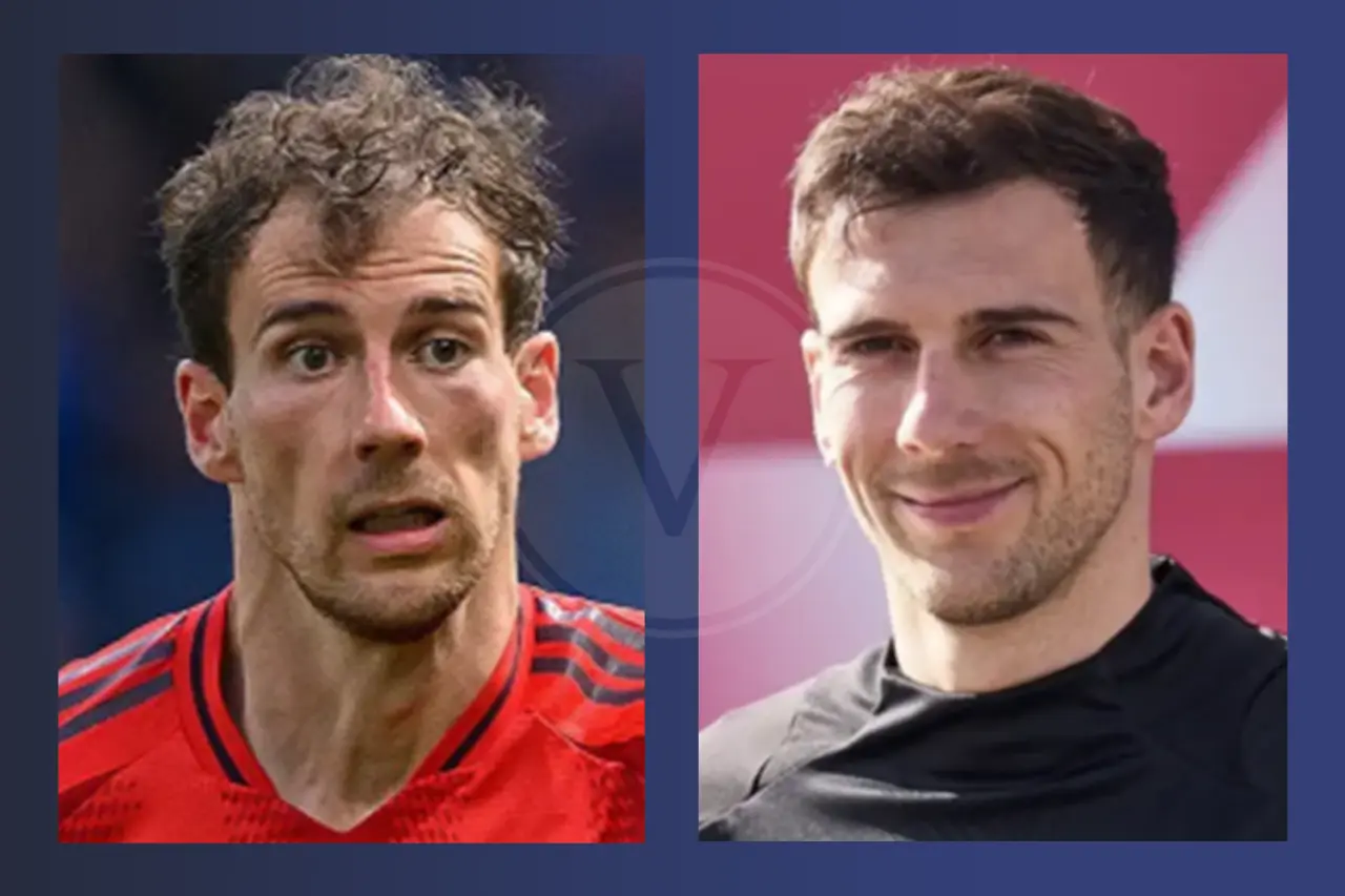 Leon Goretzka Haare vorher und nachher