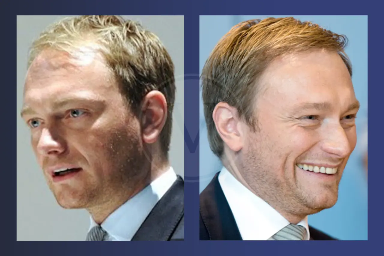 Christian Lindner Haartransplantation: Vorher und Nachher