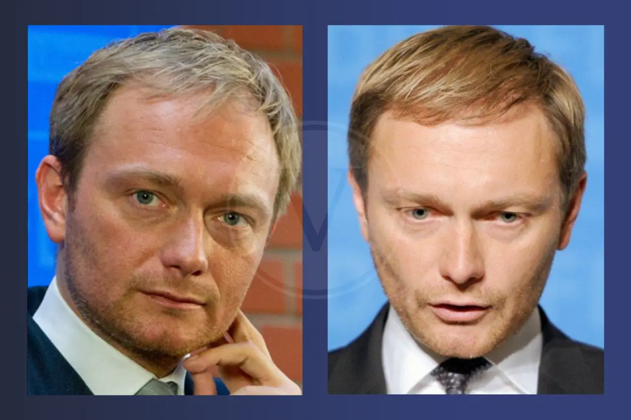 Christian Lindner Haartransplantation: Vorher und Nachher