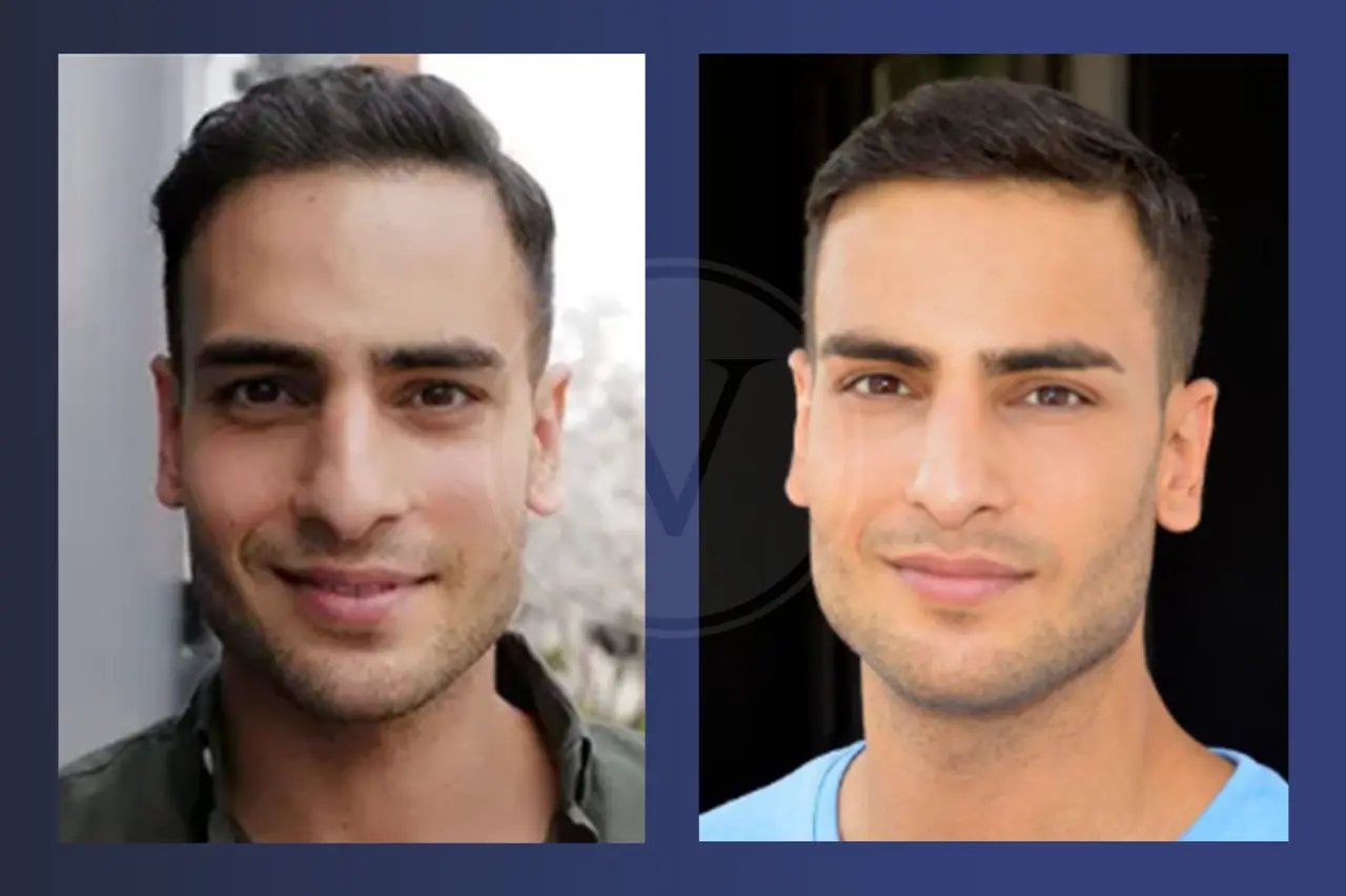 Timur Ülker Haare: Vorher und Nachher