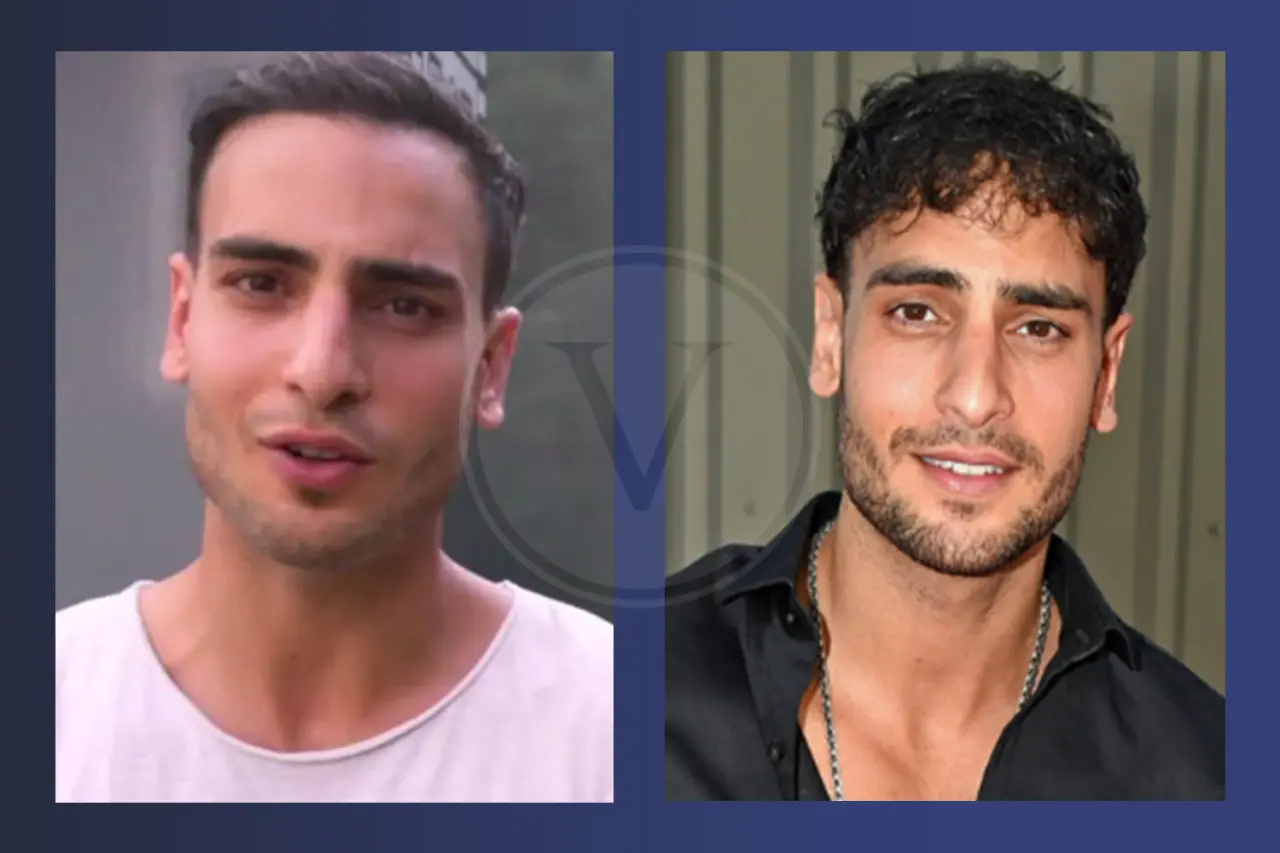 Timur Ülker Haare: Vorher und Nachher